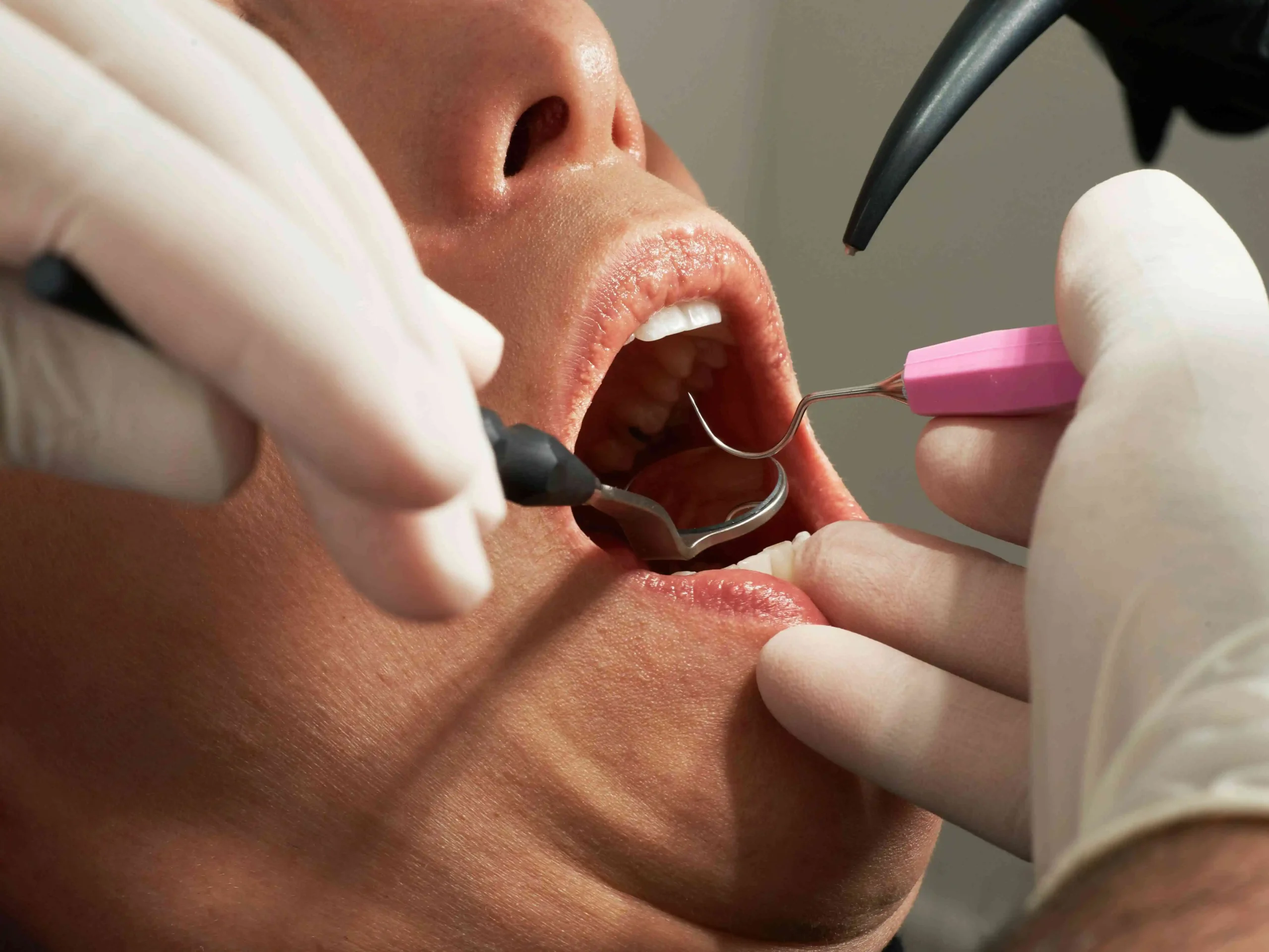 Examen dentaire : gros plan d'un dentiste examinant les dents d'un patient avec des outils.