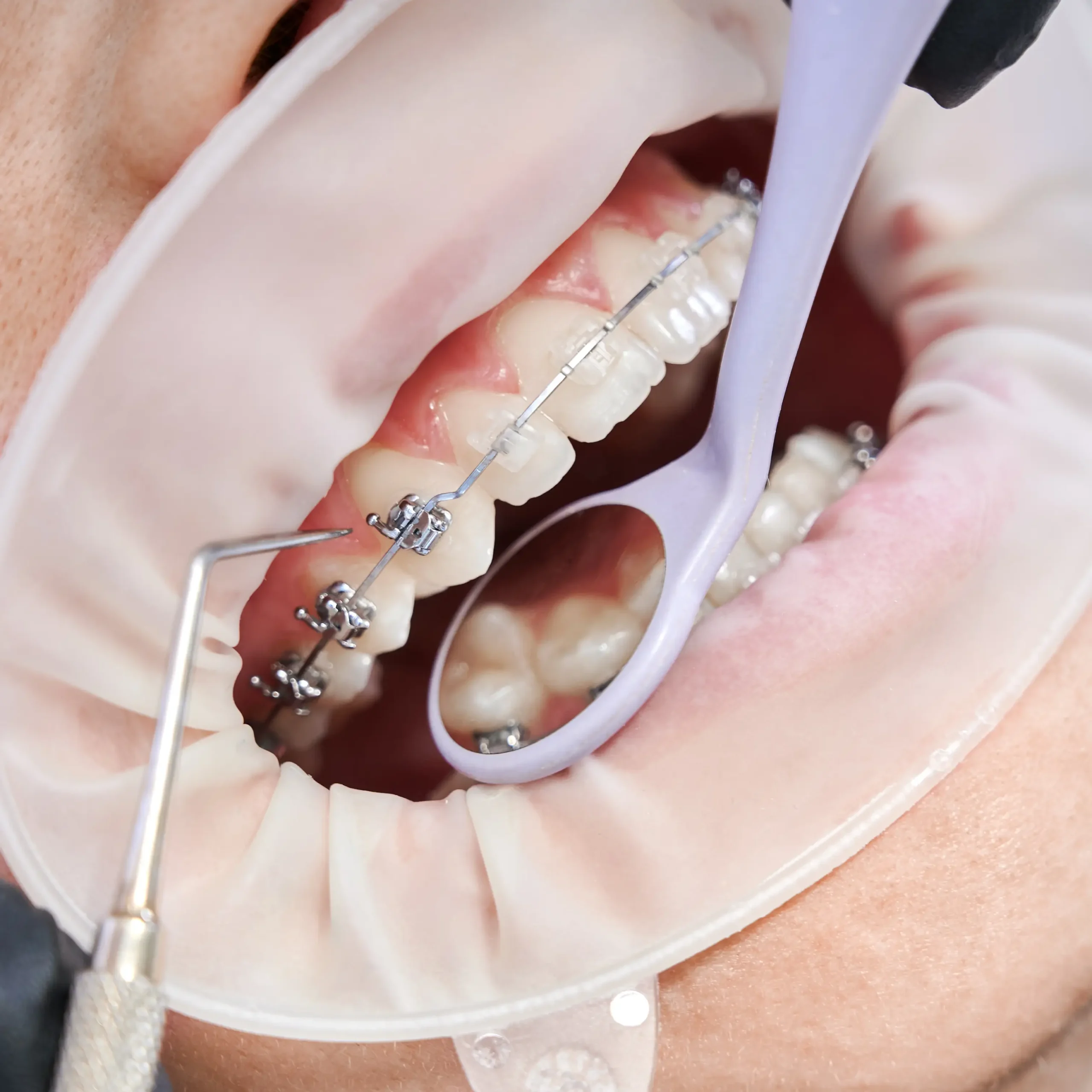 Dents avec appareil orthodontique métallique, examinées avec un miroir dentaire.