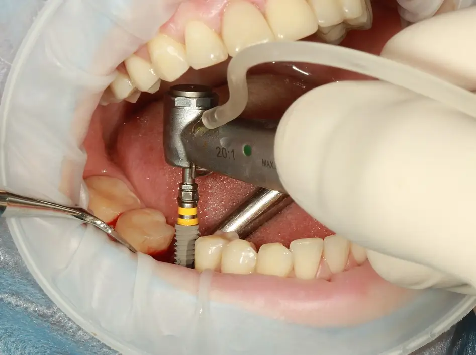 Pose d'un implant dentaire avec instrument chirurgical en bouche.