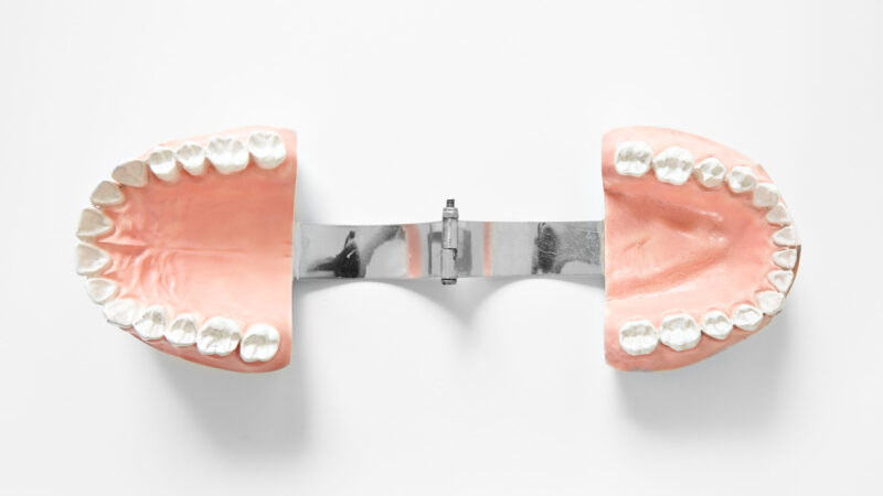 Modèle dentaire divisé montrant la formation dentaire, outil pour l'étude de la dentisterie.