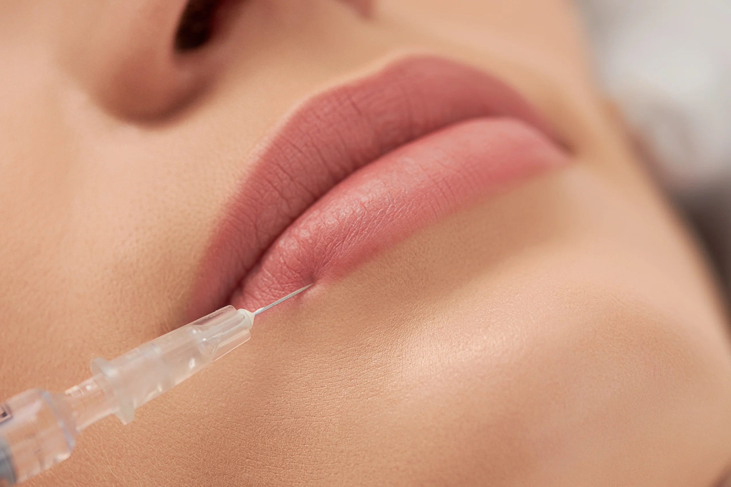 Injection d'acide hyaluronique pour l'augmentation des lèvres. Traitement esthétique.