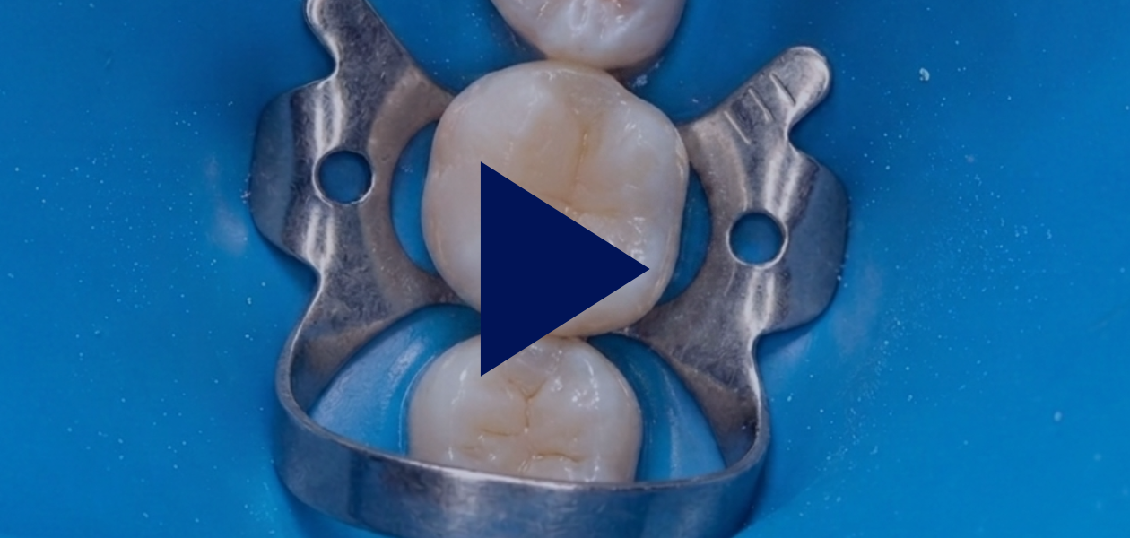 Dents isolées avec une digue dentaire bleue et un crampon. Vidéos Cliniques.