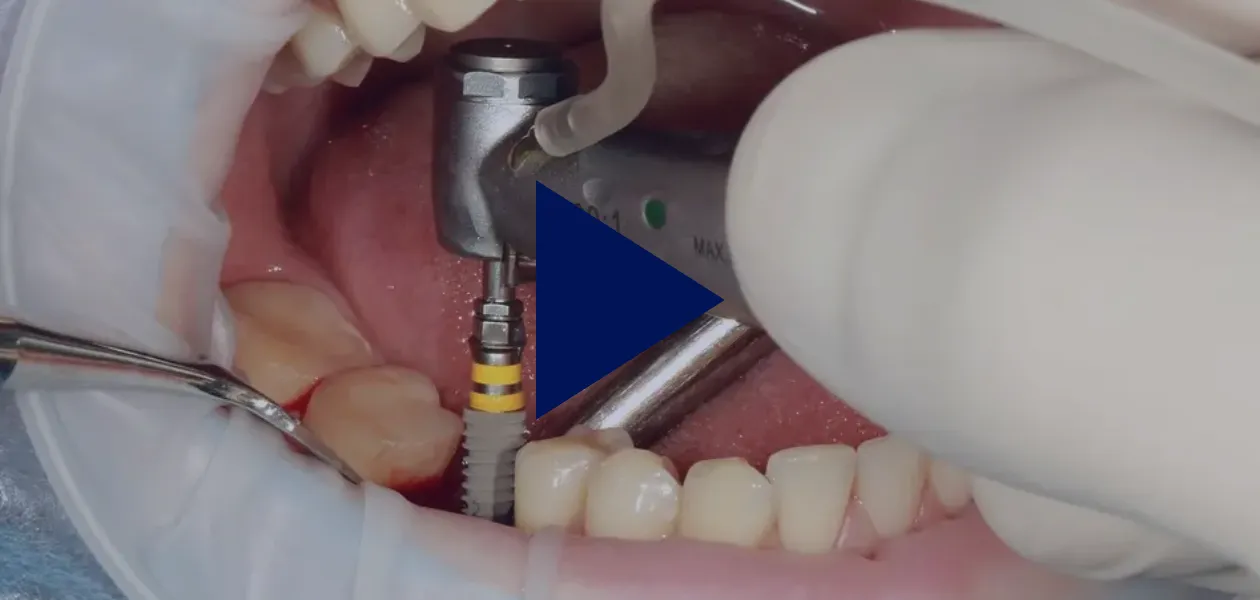 Implant dentaire inséré avec un outil spécialisé, soins dentaires.